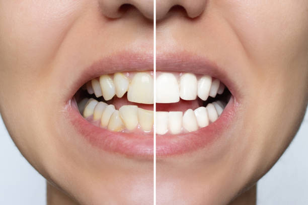 Teeth Alignment Before and After